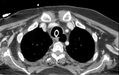 Chiusura endoscopica di fistola tracheoesofagea post COVID 19 mediante un Ampltazer septal occluder