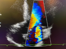 MITRAL-CLIP per VALVULOPATE MITRALICHE
