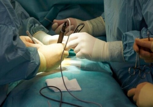 Policlinico di Bari, eseguito intervento chirurgico per il trattamento del linfedema con tecnica innovativa: è il primo in Europa