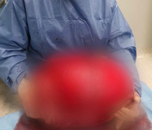 Policlinico di Bari, rimosso un fibroma dell’utero da 20 chili
