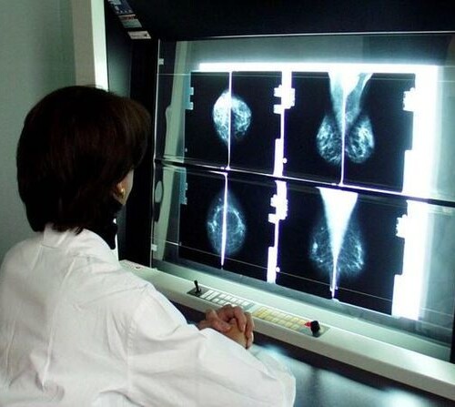 Tumore al seno, il Senato approva mozione bipartisan: screening per prevenzione e diagnosi precoce dai 25 anni