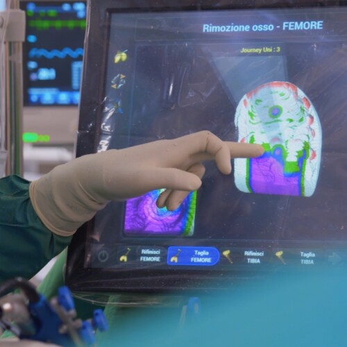 Un robot per protesi di ginocchio precise al millimetro: a Villa Lucia Hospital il primo sistema robotico Navio della Puglia