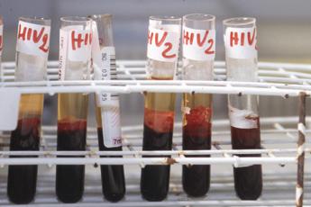 Aids, taglia-incolla del Dna per curare l’Hiv: “Entro 2 anni dati decisivi”