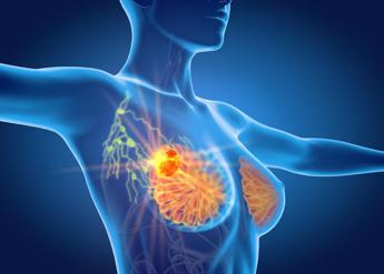Cancro seno metastatico per 37mila italiane, Aiom: “Biopsia liquida cruciale”