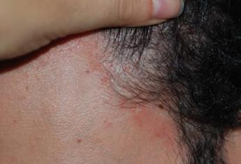 Costanzo (Humanitas): “Jak inibitori utili in comorbidità di dermatite atopica”