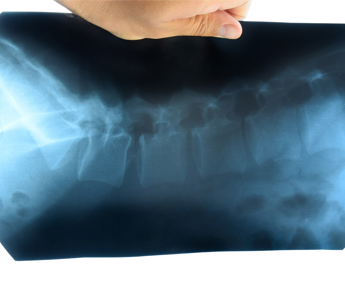 Ucb, dati positivi bimekizumab a 5 anni contro spondilite anchilosante