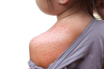 Morbillo, italiani creano database mondiale pubblico con dati aggiornati
