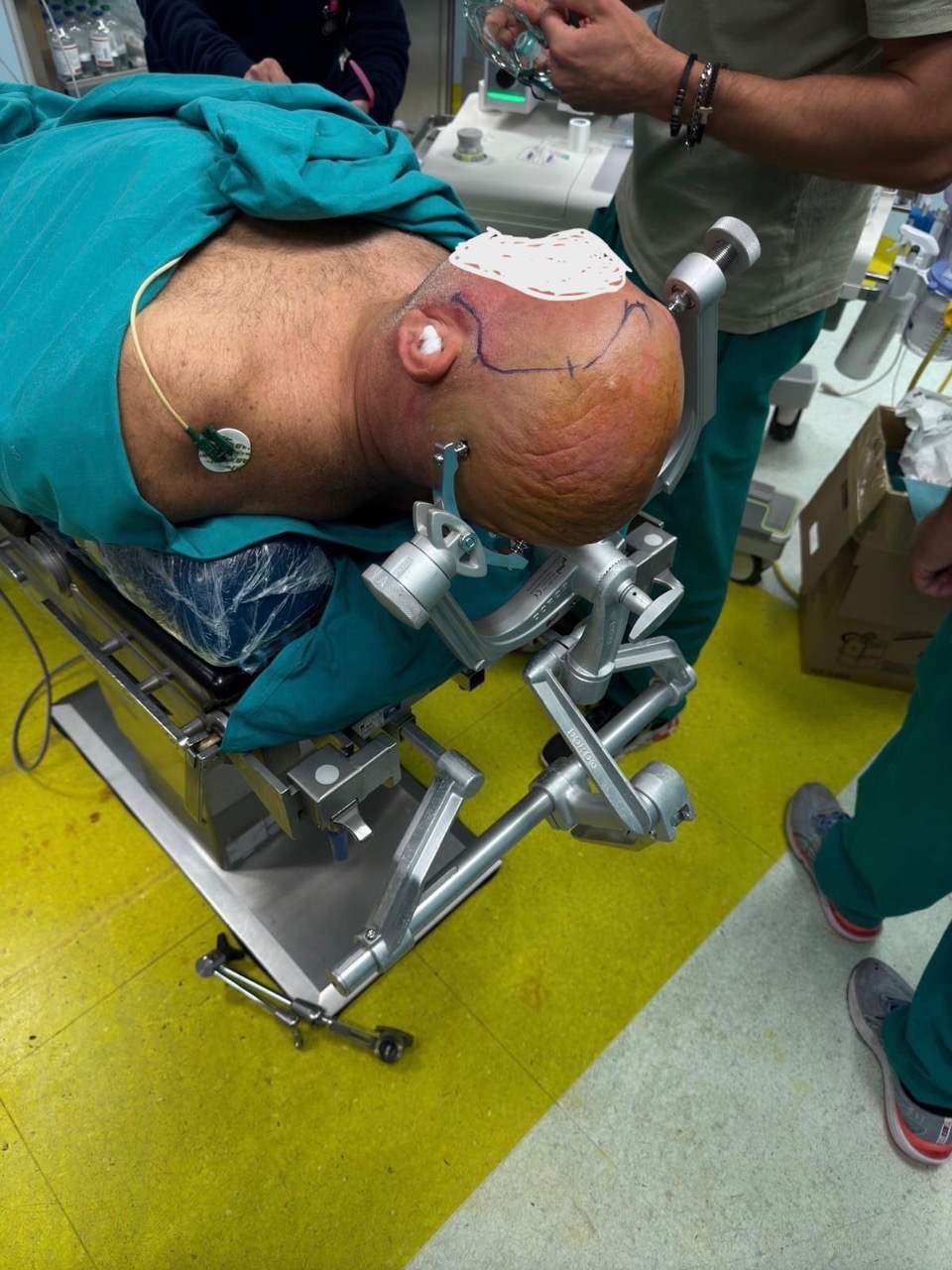 BARI, OPERATO AL CERVELLO DA SVEGLIO DAL TEAM DI NEUROCHIRURGIA DEL MATER DEI HOSPITAL